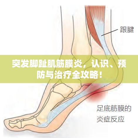 突發(fā)腳趾肌筋膜炎，認(rèn)識(shí)、預(yù)防與治療全攻略！